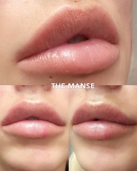After lip treatment