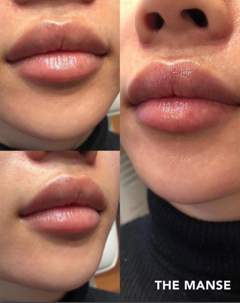 After lip treatment