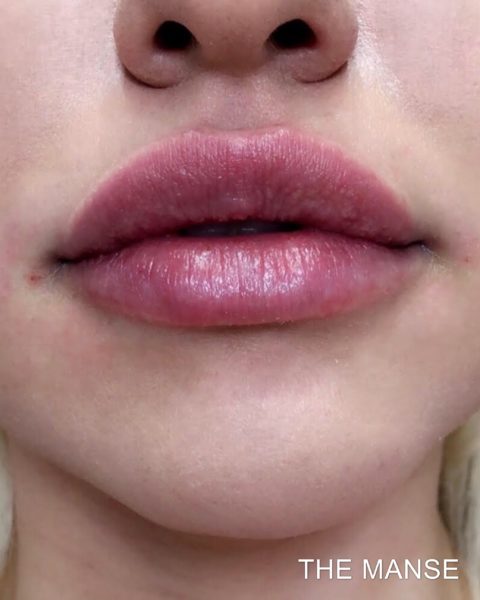 After lip treatment, The Manse