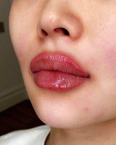 After lip treatment