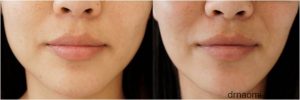 Before and 8 weeks after 1 treatment for jawline slimming