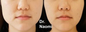 Before and 8 weeks after 1 treatment of masseter treatment for slimming