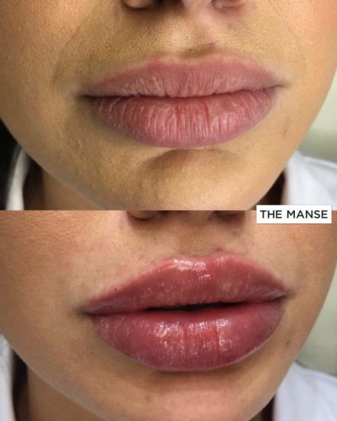 Before and After Lip Treatment