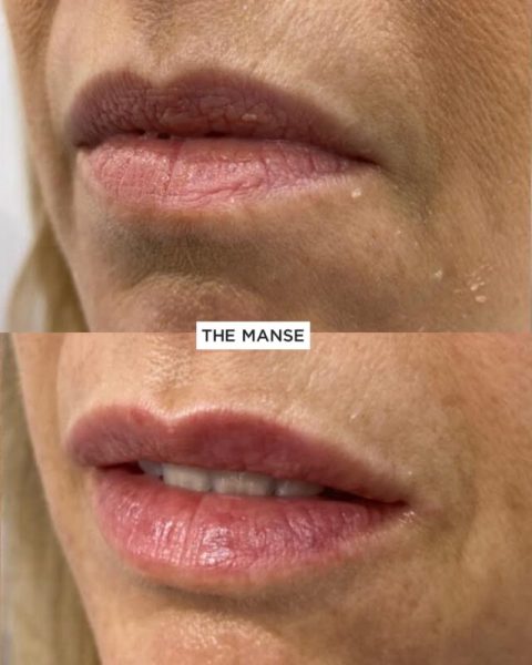 Before and After Lip Treatment