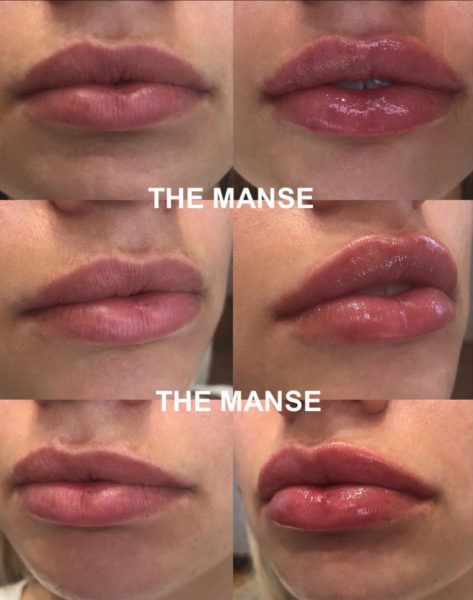Before and After Lip Treatment