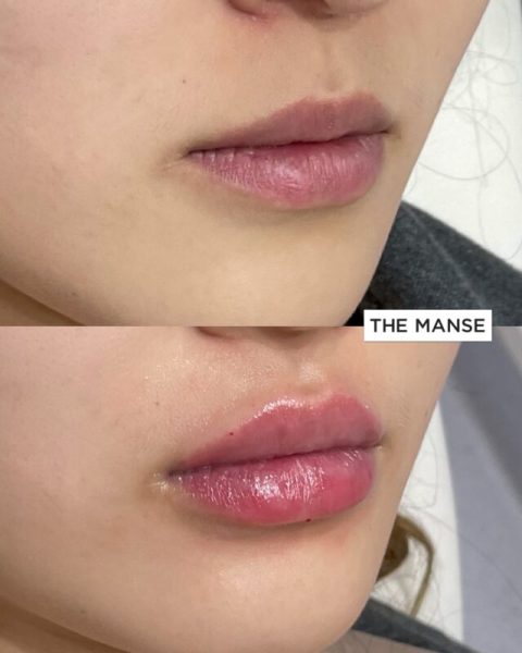 Before and After Lip Treatment