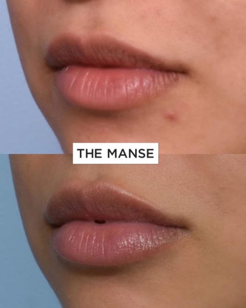 Before and After Lip Treatment