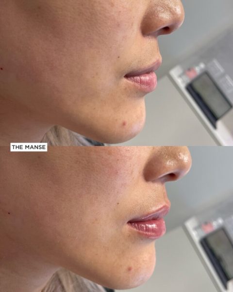 Before and After Lip Treatment