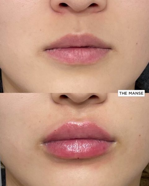 Before and After Lip Treatment