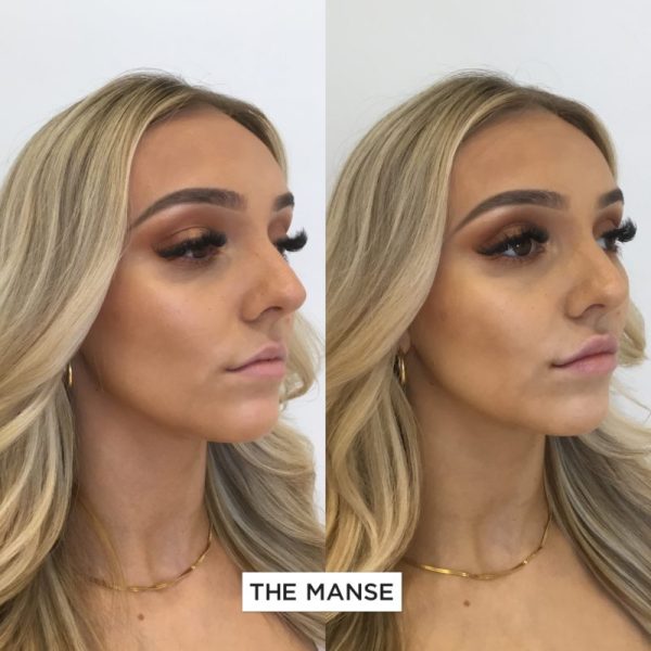Before and After Lip Treatment