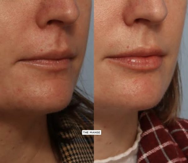 Before and After Lip Treatment