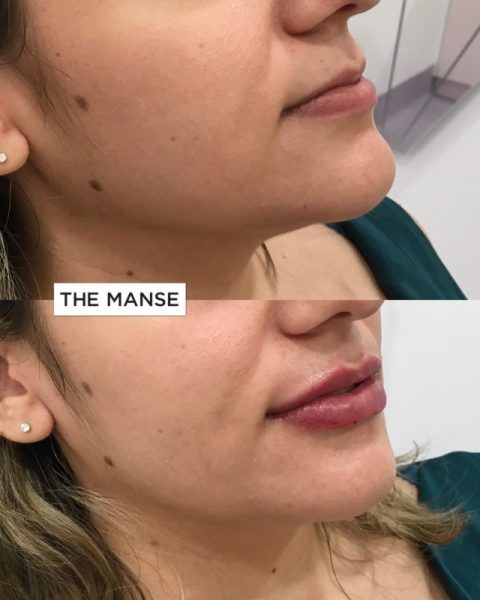 Before and After Lip Treatment
