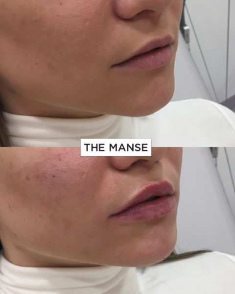 Before and After Lip Treatment