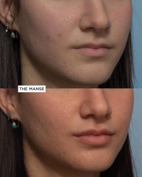 Before and After Lip Treatment