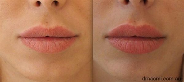 Before and After Lips