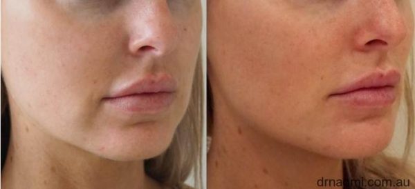 Before and After treatment to address marionettes, jawline, chin, cheeks and nasolabial folds