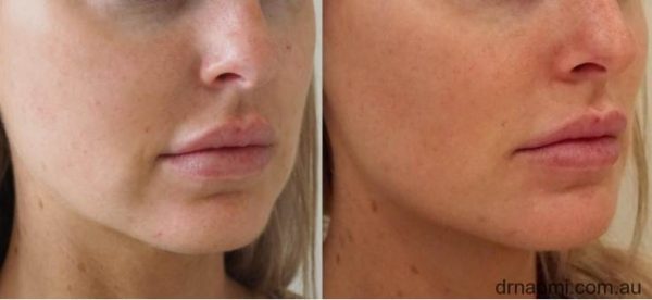Before and After treatments to marionettes, jawline, chin, cheeks and nasolabial folds