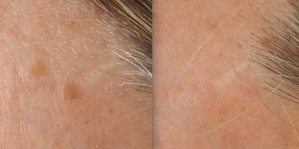 Before and after 1 treatment of erbium laser to 2 old age warts (seborrhoeic keratoses) on forehead