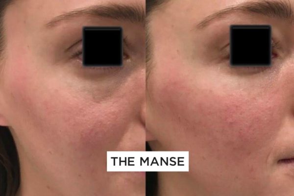 Before and after 1 treatment of tear troughs