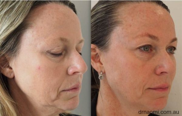 Before and after 1 treatment to address jawline, sagging, jowls and lower face ageing