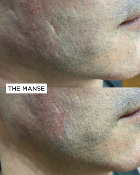 Before and after 1 treatments to scar 