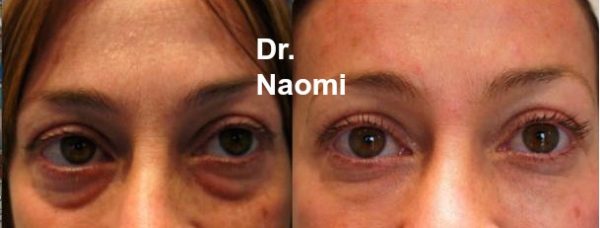 Before and after 3 treatments severe tear troughs.
