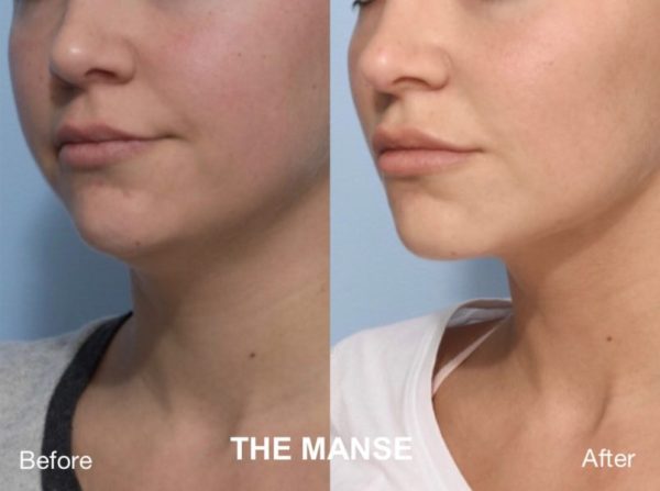 Before and after Double chin treatments
