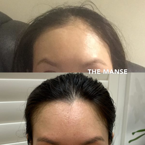 Before and after PRP and other treatments for hair loss