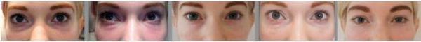 Before and after a series of treatments for tear troughs
