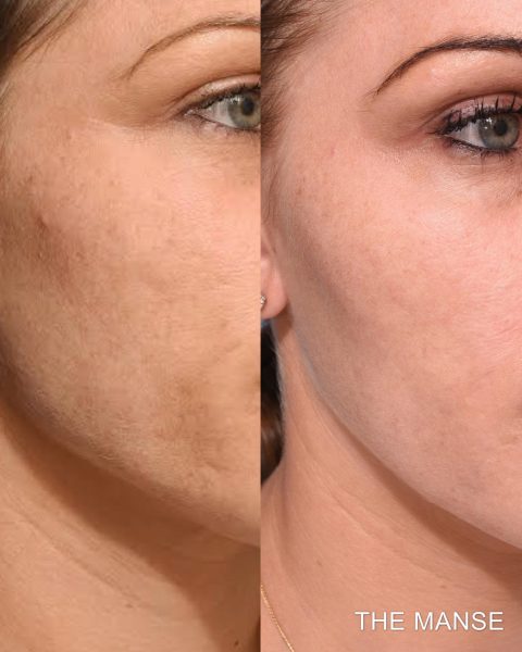 Before and after acne scarring treatments using energy based devices and skinboosters.