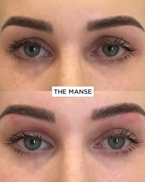 Before and after aframe treatment