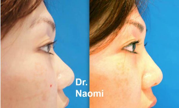 Before and after asian nose bridge treatment