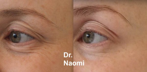 Before and after brow lifting