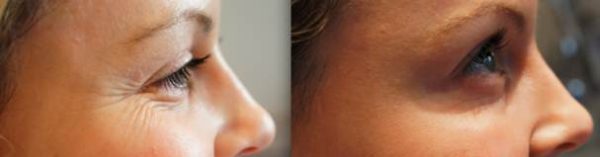 Before and after crows feet Treatment