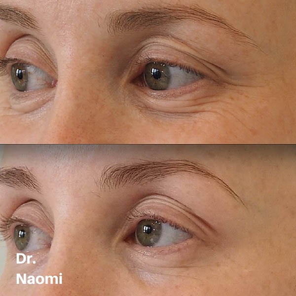 Before and after crows feet treatment