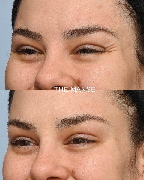 Before and after crows feet wrinkle treatment and brow lift