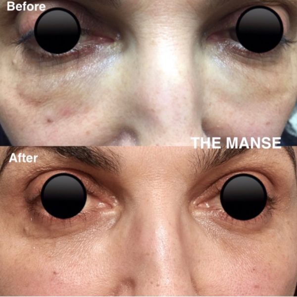 Before and after dissolver under eyes