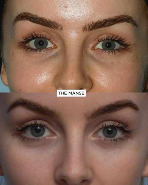 Before and after complication treatment in tear troughs