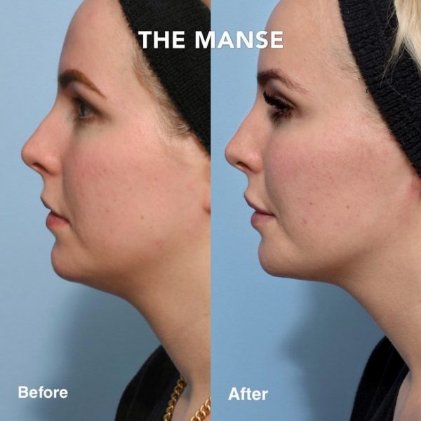 Before and after double chin treatment