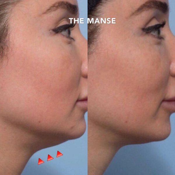 Before and after double chin treatment