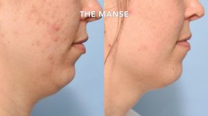 Before and after double chin treatments