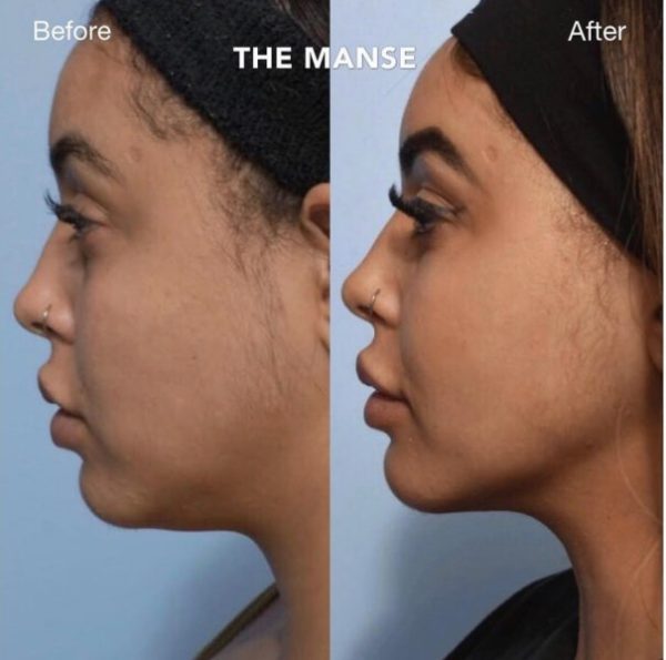 Before and after double chin treatments