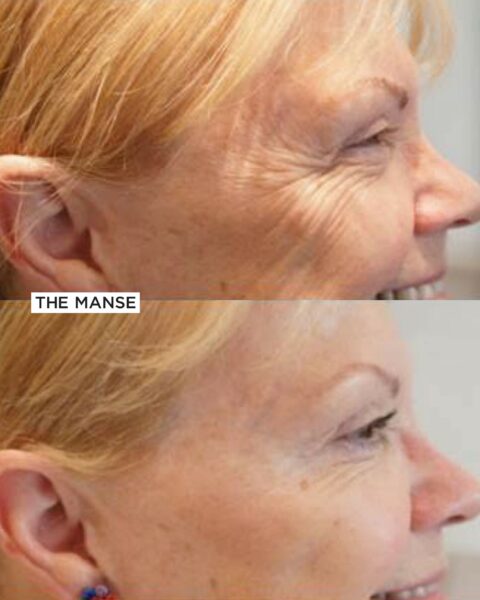 Before and after eye wrinkle treatment