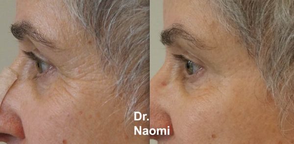 Before and after eye wrinkle treatments