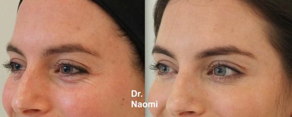 Before and after eye wrinkle treatments