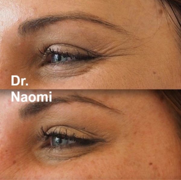 Before and after eye wrinkle treatments