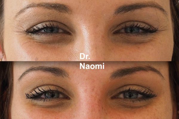 Before and after eye wrinkle treatments