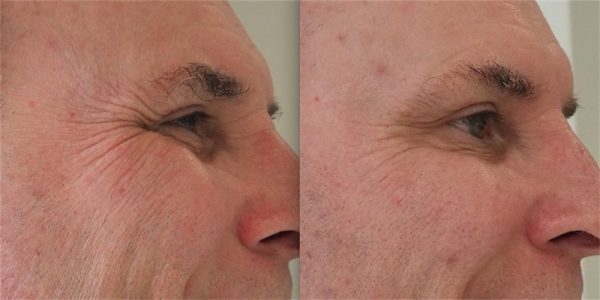Before and after eye wrinkle treatments male