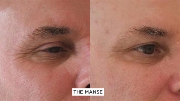 Before and after eye wrinkle treatments, natural and softened on a male 
