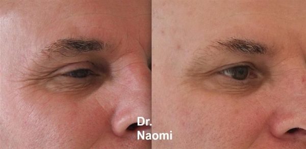 Before and after eye wrinkle treatments not smiling